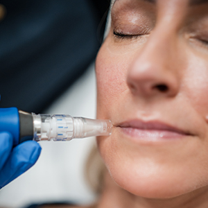 Microneedling